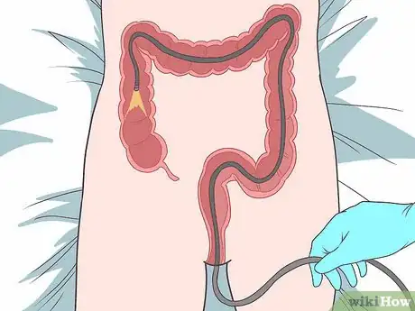 Imagen titulada Stop Rectal Bleeding Step 7