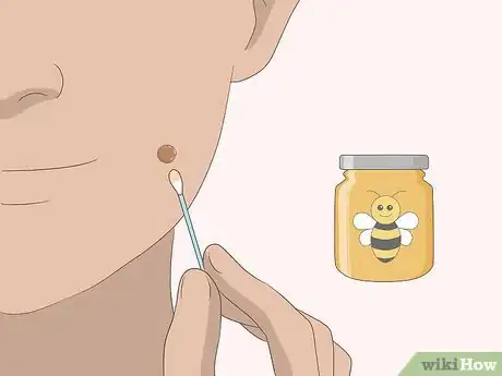 Imagen titulada Remove Moles Quickly Step 15