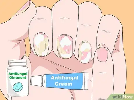 Imagen titulada Get Rid of Psoriasis on Your Nails Step 8