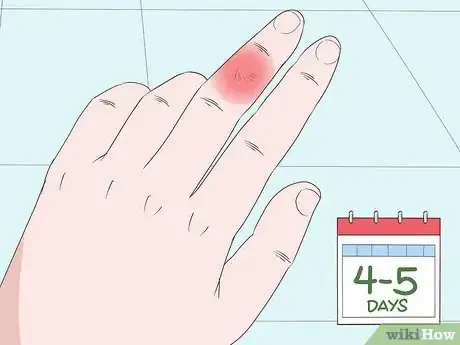 Imagen titulada Cure an Infected Finger Step 9