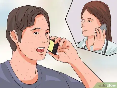 Imagen titulada Recognize Chickenpox Step 7