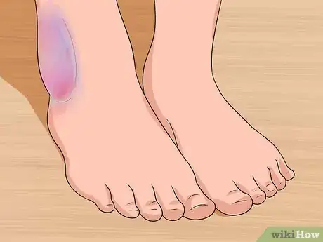 Imagen titulada Know if You've Sprained Your Ankle Step 2