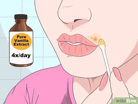 Imagen titulada Treat a Cold Sore or Fever Blisters Step 23