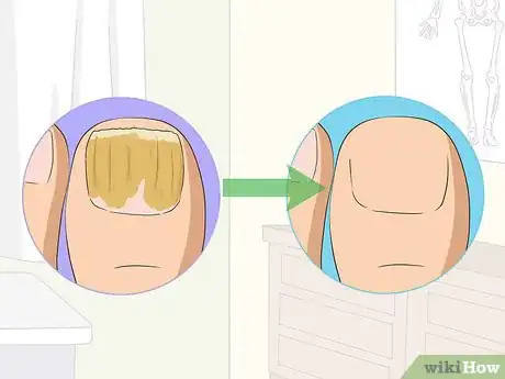 Imagen titulada Treat Toe Nail Fungus Step 10