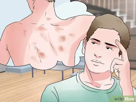Imagen titulada Reduce Bruising Step 13