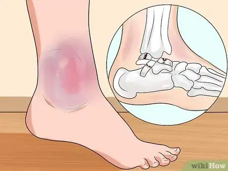 Imagen titulada Know if You've Sprained Your Ankle Step 7