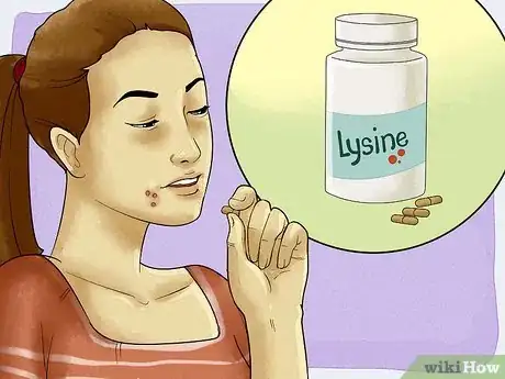 Imagen titulada Get Rid of a Cold Sore with Home Remedies Step 17