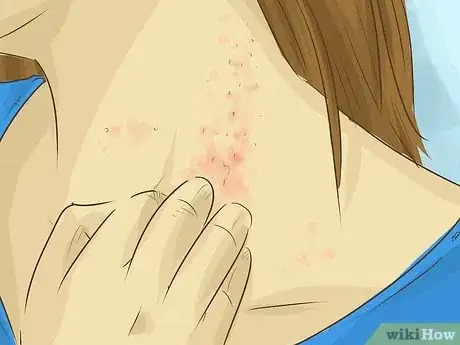 Imagen titulada Stop Scratching Irritated Skin Step 17