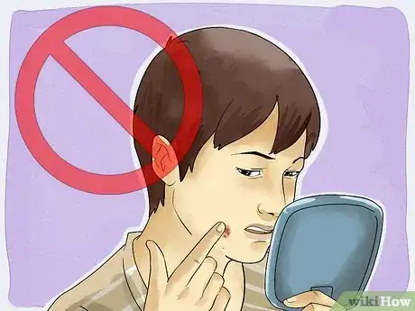 Imagen titulada Get Rid of a Cold Sore with Home Remedies Step 23