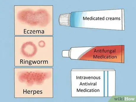 Imagen titulada Get Rid of a Rash Step 14