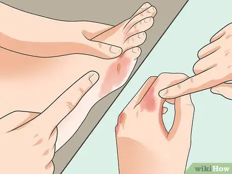 Imagen titulada Diagnose Psoriasis Step 4