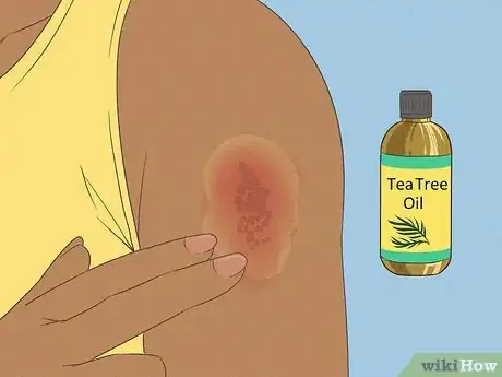 Imagen titulada Get Rid of a Rash Step 7