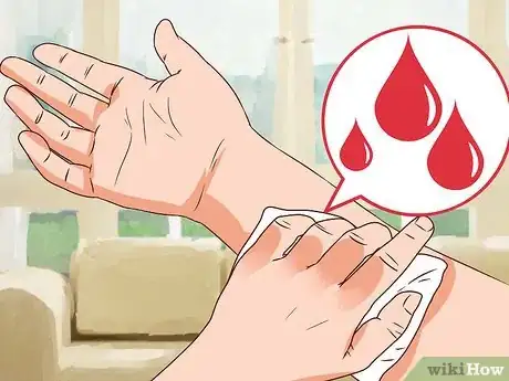 Imagen titulada Treat an Open Fracture During First Aid Step 8