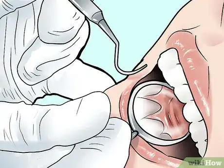 Imagen titulada Remove Plaque Step 10