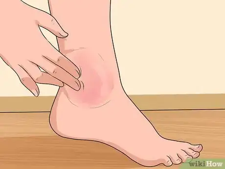 Imagen titulada Know if You've Sprained Your Ankle Step 4