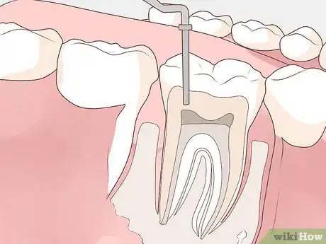 Imagen titulada Get Rid of a Gum Boil Step 3