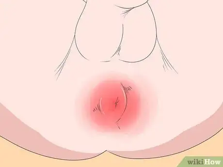 Imagen titulada Prevent Perianal Abscess from Returning Step 14