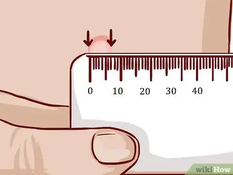 Imagen titulada Read a Tuberculosis Skin Test Step 5