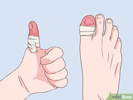 Imagen titulada Bandage Fingers or Toes Step 16