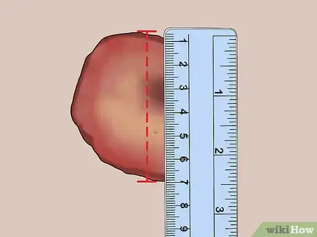 Imagen titulada Measure Wounds Step 4