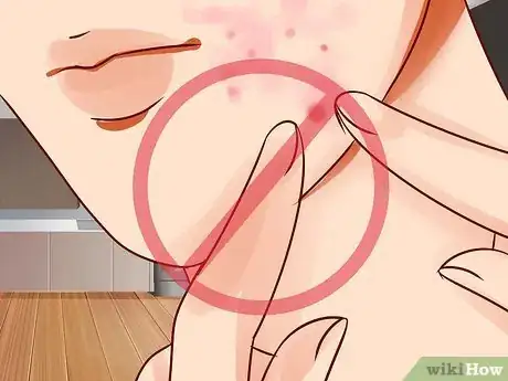 Imagen titulada Get Rid of a Deep Pimple Step 2
