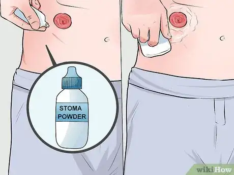 Imagen titulada Change a Colostomy Bag Step 6