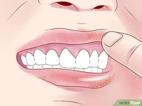 Imagen titulada Tell if You Have Mouth Cancer Step 4
