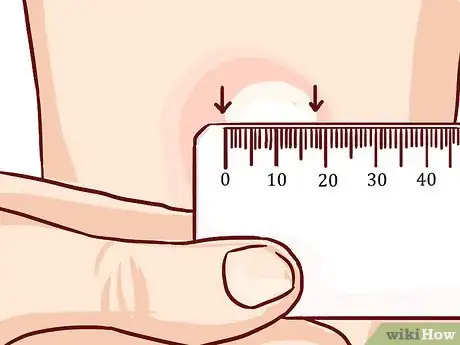 Imagen titulada Read a Tuberculosis Skin Test Step 8