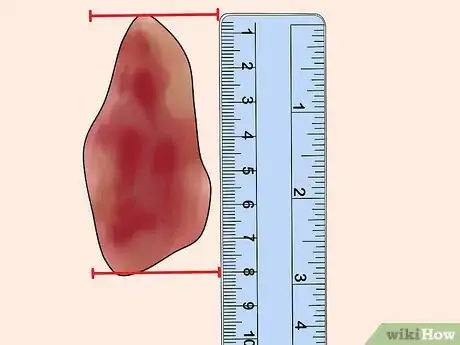 Imagen titulada Measure Wounds Step 3