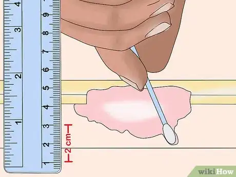 Imagen titulada Measure Wounds Step 7