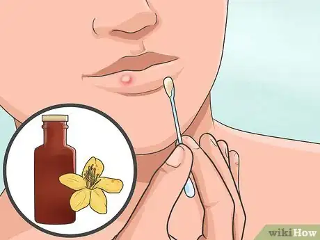 Imagen titulada Heal a Cold Sore Naturally Step 12