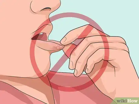 Imagen titulada Heal a Cold Sore Naturally Step 13