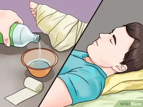 Imagen titulada Treat a Sea Urchin Sting Step 8