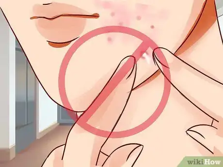 Imagen titulada Get Rid of a Deep Pimple Step 15
