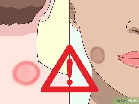 Imagen titulada Treat Tinea Step 6