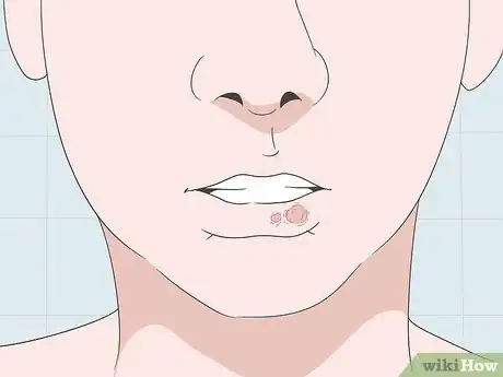 Imagen titulada Cover Up a Cold Sore Step 1