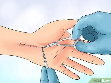 Imagen titulada Exercise After Carpal Tunnel Surgery Step 14