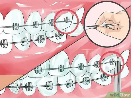 Imagen titulada Handle Poking Wires on Braces Step 7