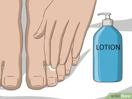 Imagen titulada Get Rid of Chilblains Step 11