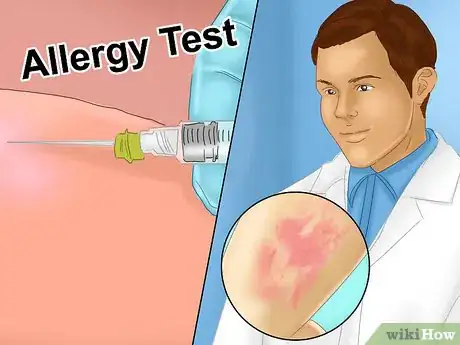 Imagen titulada Recognize Hives (Urticaria) Step 11