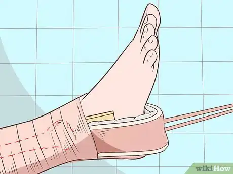 Imagen titulada Apply a Skin Traction Step 6