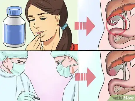 Imagen titulada Dissolve Gallstones Step 4
