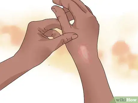 Imagen titulada Identify and Treat Ringworm Step 4