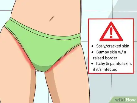 Imagen titulada Treat Tinea Step 2