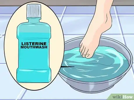 Imagen titulada Cure an Infected Toe Step 11