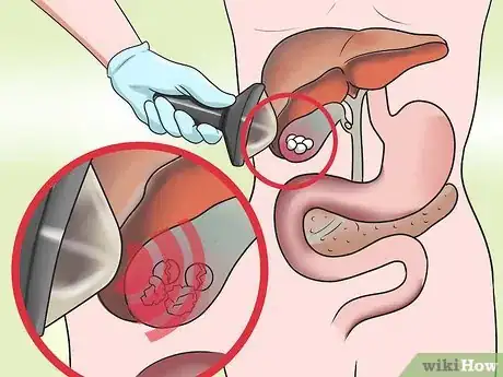 Imagen titulada Dissolve Gallstones Step 3