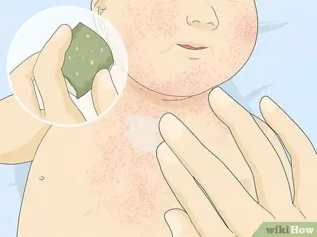 Imagen titulada Treat Baby Heat Rash Step 5