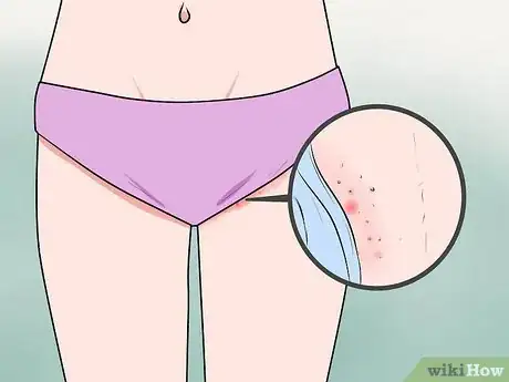 Imagen titulada Recognize Vulva Cancer Symptoms Step 1