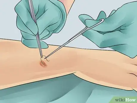 Imagen titulada Heal from a Skin Biopsy Step 10