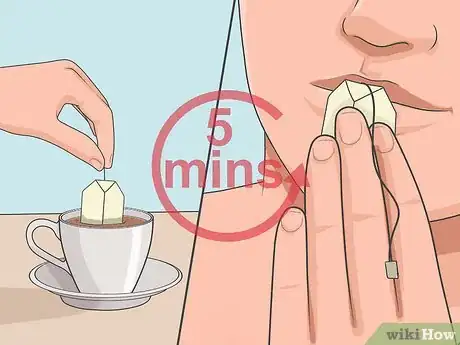 Imagen titulada Heal a Cold Sore Naturally Step 10